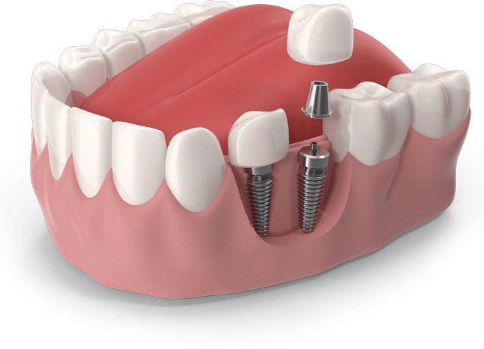 Dental Implants Service